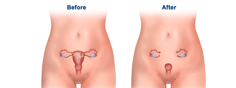 Hysterectomy Surgery Specialist in Malad